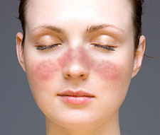 LUPUS, L’IRA DEI MALATI: CURE DIFFICILI