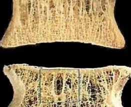 AL VIA IL X CONGRESSO DELLA SOCIETÀ’ ITALIANA DI OSTEOPOROSI